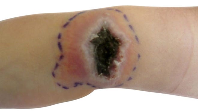 Cowpox ulcer 2 BMJ.jpg